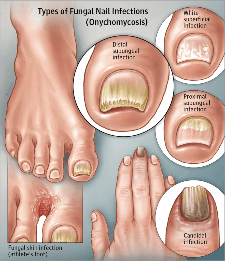 What Causes Yellow, Crumbly Nails?: Jennifer Tauber, DPM: Podiatrist